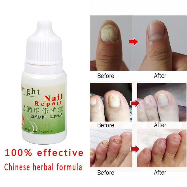 Nail Mushroom Treatment Cream, Plaster Of Chinese Medicine, Kills 100% Bacteria And Onychomycosis, 99.9% Really Easy on Productcaster.