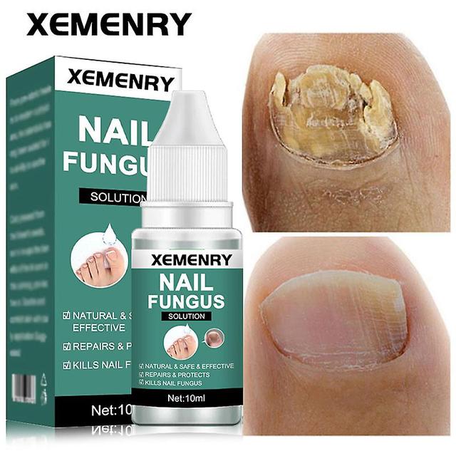 Antifungal Treatment Of Nails, Feet Care, Gasoline, Repair Of Nails, Toes, Anti-infection Gel, Paronychia 10ml on Productcaster.