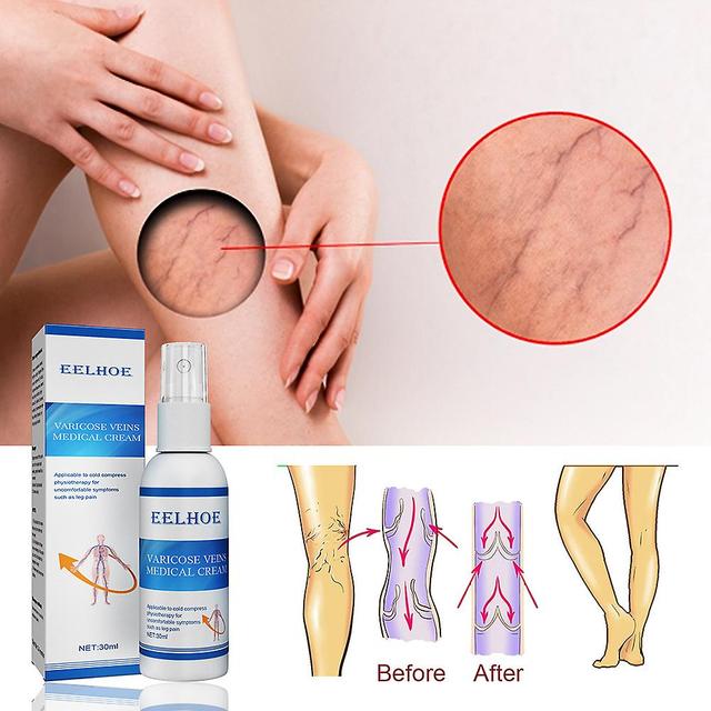 30ML Anti-Varicose Soothing Spray Improve Blood Circulations Massage Liquid on Productcaster.