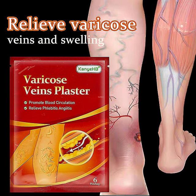 18/30/42/60pcs Varicose Veins Ointmnet Vasculitis Phlebitis Spider Cream Varicosity Angiitis Removal Herbal Medical Plaster 30pcs in 5 bags on Productcaster.