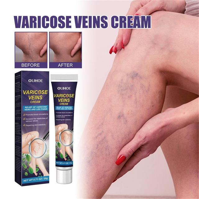 Baodan Intravenous Massage GelEarthworm Leg Vein Blue Veins Protruding Varicose Paste 20g on Productcaster.