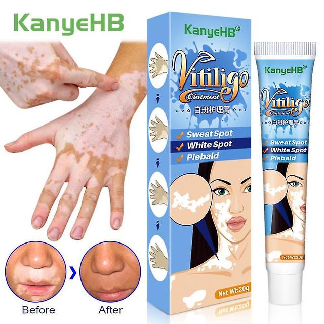 20g de extrato de ervas Vitiligo pomada remover micose remoção de manchas brancas on Productcaster.