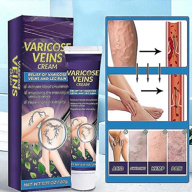 Spataderen Crème Zalf, bloedaderaders Vasculitis, spataderen Crème voor benen, vasculitis Flebitis, verlicht vermoeide, zware en pijnlijke benen 2pcs on Productcaster.