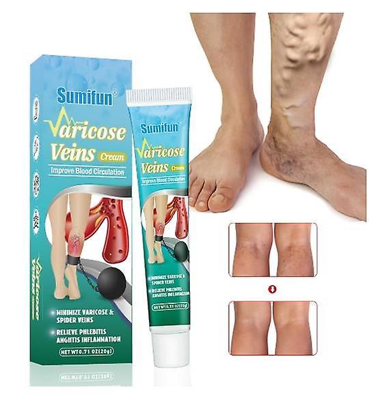 New Potent Formula Ointment For Varicose Veins Effective Varicose Vein Relief Cream To Relieve Vasculitis Phlebitis Spider Pain on Productcaster.