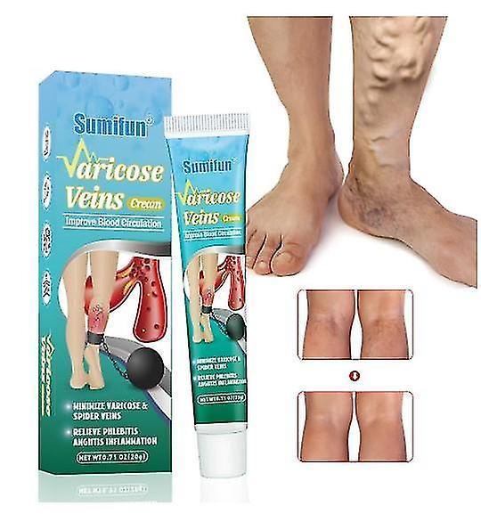 Venous Massage Varicose Cream Relieves Leg Vascular Protrusion, Varicose Veins, Earthworm Leg Repair Tool on Productcaster.