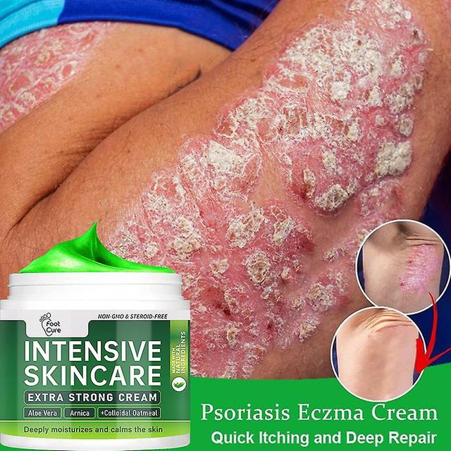 Face Anti-demangeal salve med kinesiske urter, naturlig planteekstrakt, medicinsk pleje creme til huden, psoriasis, dermatitis, eksematorid, 15g, 3... on Productcaster.