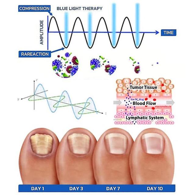 New 2024 Laser Device for Nail Fungus Treatment - Onychomycosis Light Therapy, 910nm Wavelength, 50% on Productcaster.