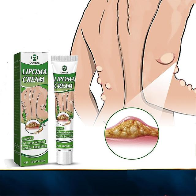 20g Lipoma Removal Cream Lipolysis Fat Lump Relief Plaster Skin Swelling Fat Elimination Cream Healt on Productcaster.