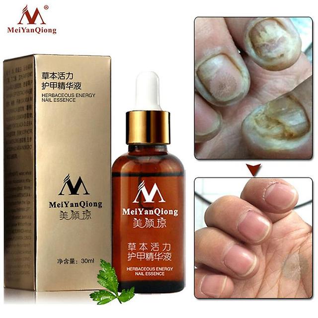 Meiyanqiong-anti-infectie gel voor nagels, voetverzorging, benzine, nagel bleken, paddestoel eliminatie, 30ml on Productcaster.