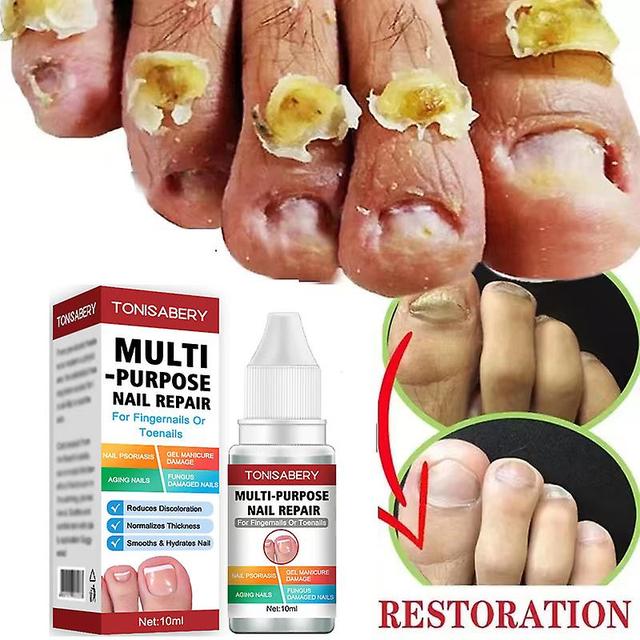 Antifungal Treatment Of Nails, Anti -beding Feet, Paronyamitity Healthcare Serum Onychomycosis, Parker Repair Of Mushrooms, 10ml 3pcs on Productcaster.