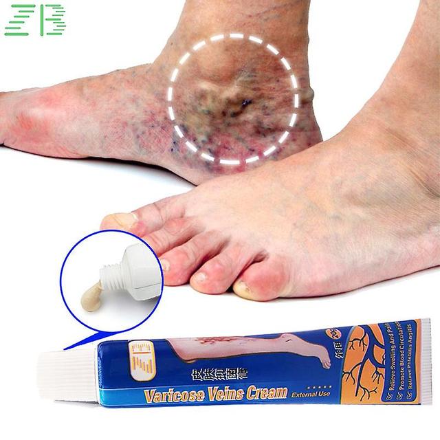 Coscelia 1pcs Varices Soulagement Crème Vascularite Jambe Phlébite Forme D’araignée Veine Douleur Pommade Chinois À Base de Plantes Plâtre Médical on Productcaster.