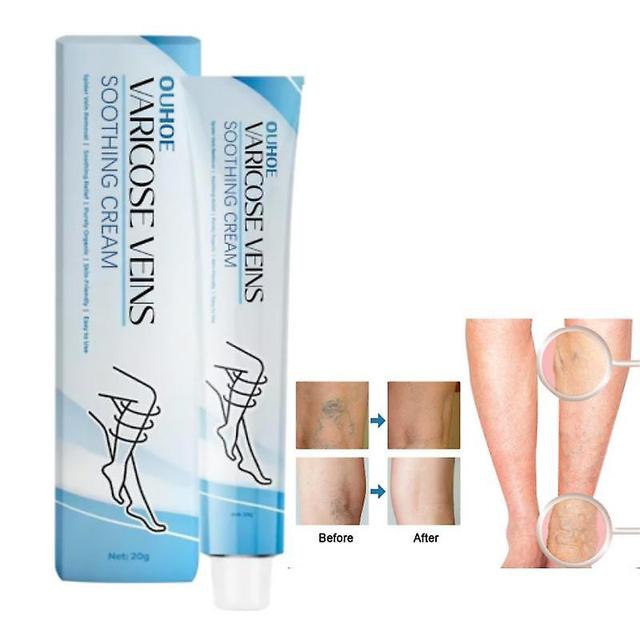 1-3pcs Varicose Vein Repair Cream,Varicose Veins Relief Cream,Improve Blood Circulation,Soothes Tired Legs 1pcs on Productcaster.