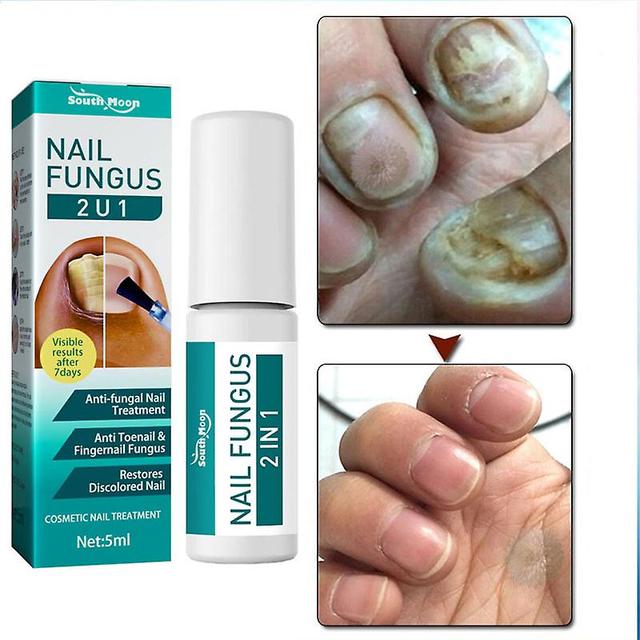 Antifungal Treatment Of Nails, Anti-determination Liquid Essence, Eliminates Paronyamitity, Onychomycosis, Repair Of Damaged Toes, Healthcare Serum... on Productcaster.