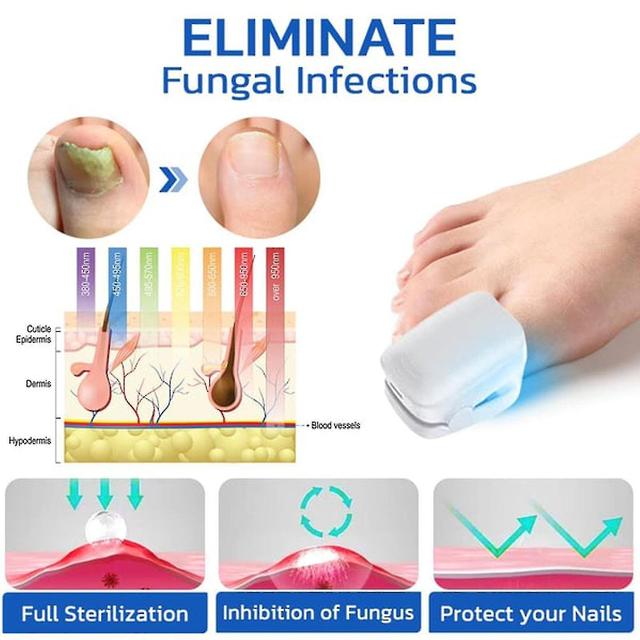 2024 NEW,Nail Fungus Laser Device Light Therapy Onychomycosis Toes Treatment 910nm,50% Offer on Productcaster.