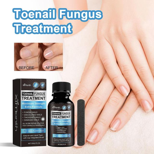 Congjing For Toenail 1PCS Toenail Extra Strength For Repairing Damaged And Discolored Nails Blue30ml on Productcaster.