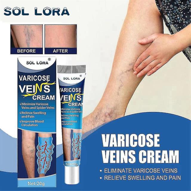 Venous Massage Varicose Cream Relieves Leg Vascular Protrusion, Varicose Veins, Earthworm Leg Repair Tool on Productcaster.