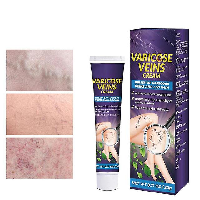 Jingdong 20g 1/2pcs Varicose Veins Cream Against Spider Veins, Varicose Vein & Soothing Leg Cream, Improve Blood Circulation For Leg on Productcaster.