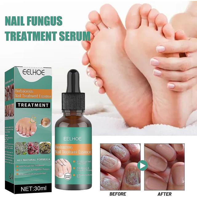 Fluid Toenail And Solution Toenails And Nails Damaged And Discolored Nails 30ml Fff on Productcaster.