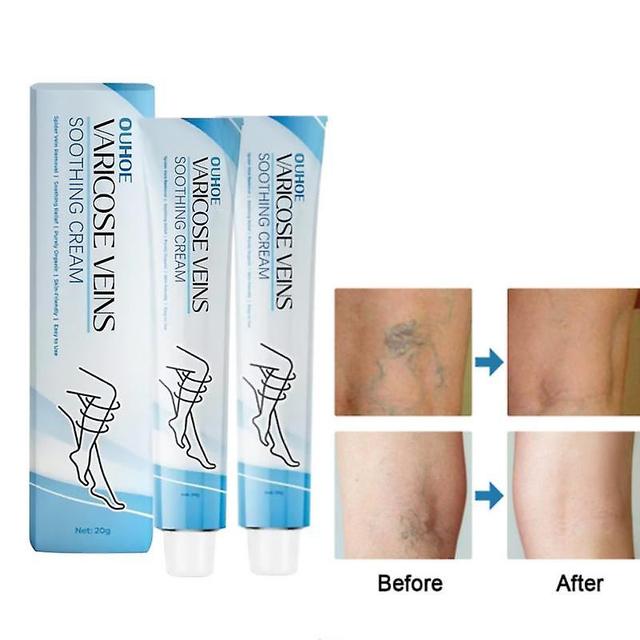 1-3pcs Varicose Vein Repair Cream,Varicose Veins Relief Cream,Improve Blood Circulation,Soothes Tired Legs 2pcs on Productcaster.