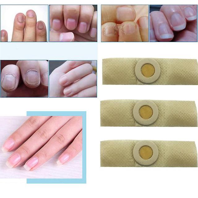 Qian Best Chinese Medicine Herbs Nail Treatment Cream Paronychia Anti Nail Infection Fights Bacteria And Naturally 3pc nail patch on Productcaster.