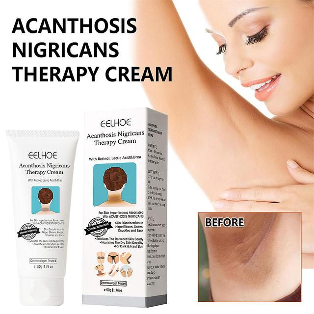 Acanthosis Cream Nigrifix Cream For Acanthosis Nigricans Black Spot on Productcaster.