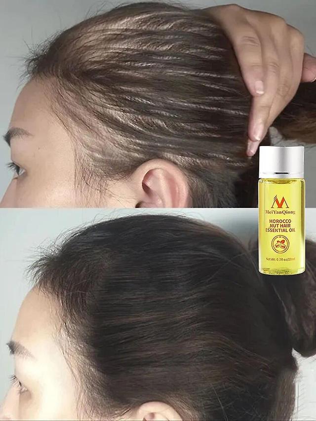 Fast Powerful Hair Growth Essence Hair Loss Products Essential Oil Liquid Treatment Preventing Hair Loss Hair Care Products 20mlHair Loss Treatments on Productcaster.