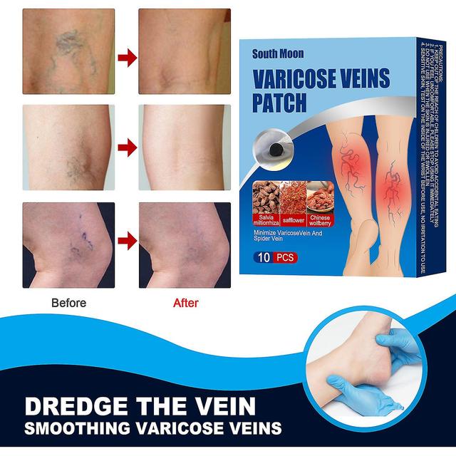 10pcs Varices Varices Plâtre Soins de santé Extrait naturel d’herbes Autocollant Cure Varicosité Angiite Remède Soulagement de la douleur Patch on Productcaster.