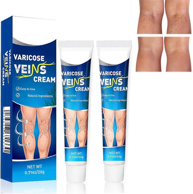 Set Of 2 Varicose Veins, Varicose Vein Vasculitis, Varicose Veins Effective Varicose Veins, Inflammation Of Varicose Veins 2pcs on Productcaster.