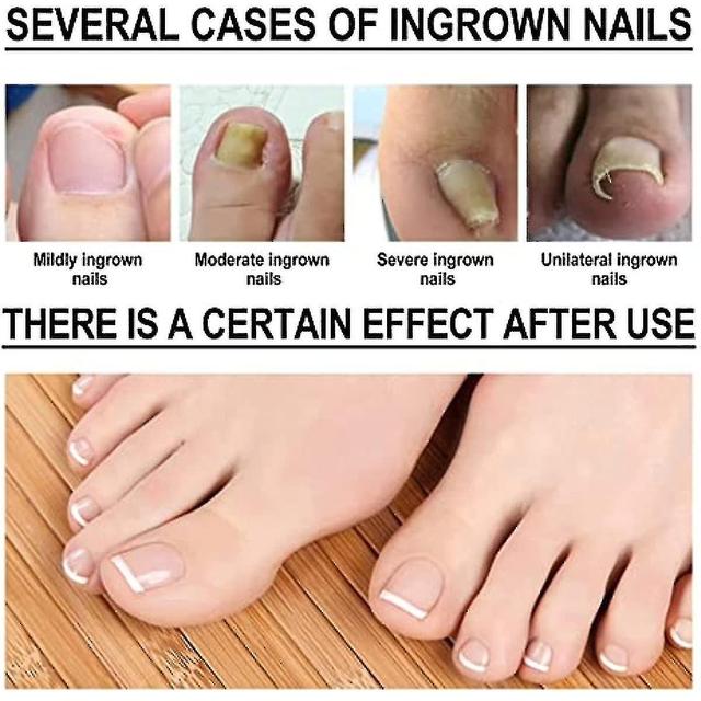 Gunest Nail Helper Ingrow Toenail Correction Treatment Oil Ingrown Toenail Correction Drops Cuticle Care Oils For Ingrown Toenail 30 ml Pack of 1 on Productcaster.