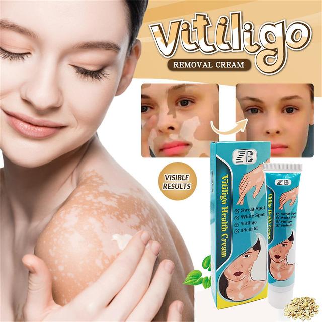 Qian 20g Extrait À Base De Plantes Vitiligo Pommade Enlever La Teigne Éliminer Les Taches Blanches Peau Leucoplasie Maladie De Traitement Crème on Productcaster.