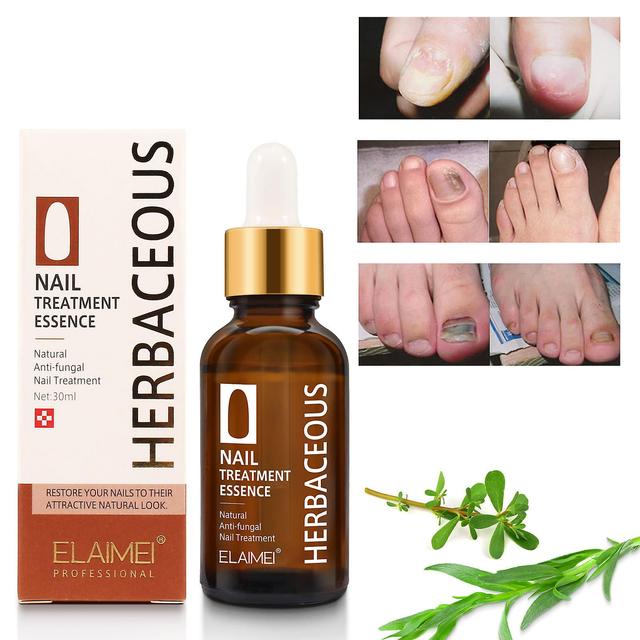 Congjing Toenailplus Anti-Paronychia Relief Oil Ingegroeide Teennagel Druppels Correctie Teennagelverzachter Nail Helper Ingrowth Teennagel Herstel... on Productcaster.