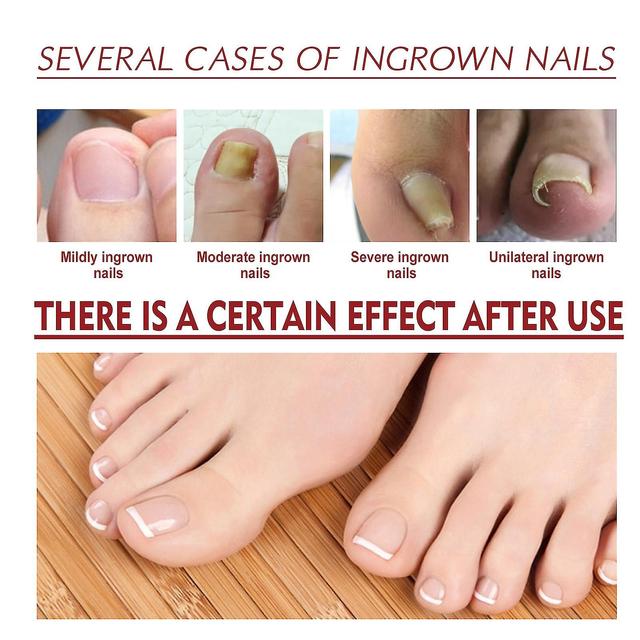 Anti Paronychia Relief Oil- Ingrown Toenail Treatment, Nail Real Liquid For Damaged & Discoloration Nail on Productcaster.