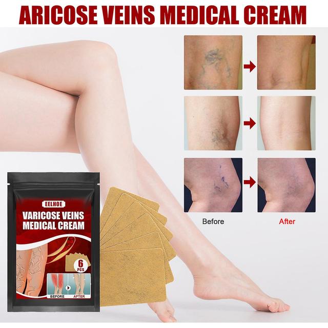 EELHOE Vein Massage Varicose Plaster Patch for Leg Swelling Earthworm Leg Vein Massage Pain Relief 6pcsVein patch on Productcaster.