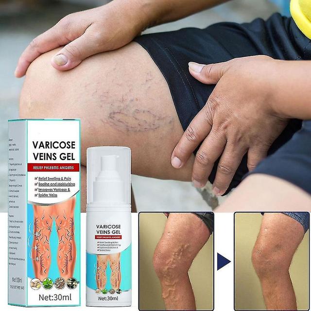 Varicose Veins Gel, Varicose Veins Cream, Varicose Vein Ointment Against Spider Veins, Varicose Vein on Productcaster.