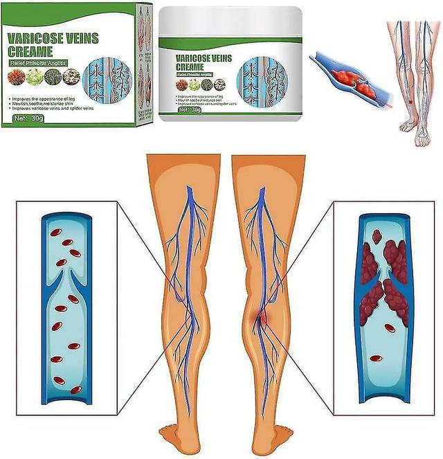 Varicose Veins Cream,varicose Vein Cream For Legs,eliminate Varicose Veins And Spider Veins,relieve Pain And Itching Of Legs 3 Pcs on Productcaster.