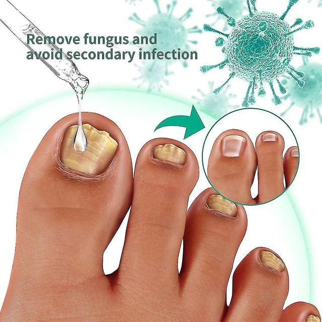 2pcsx30ml Toenail Fungus Treatment, Healthy Skin, Hair Nails For Toenail Fungus on Productcaster.