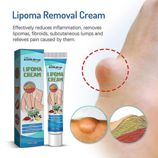 New Style 2x New Lipoma Removal Cream Lipoma Treat Skin Swelling Delipidation Cream on Productcaster.