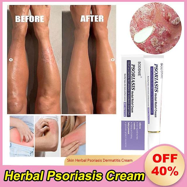 Face Plant-based Treatment Ointment For Psoriasis, Anti-mangy Cream, Eczegypti, Rash, Urticaria, Health Care, Skin Care 1pcs on Productcaster.