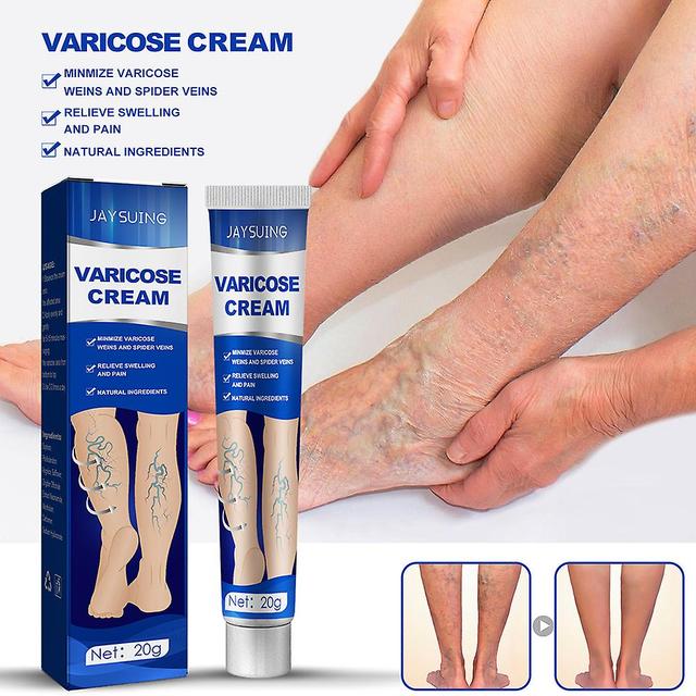 Sslzw Varicose Vein Cream per vasi sanguigni Gonfiore gamba sollevata Vasculite flebite Impostazione predefinita on Productcaster.