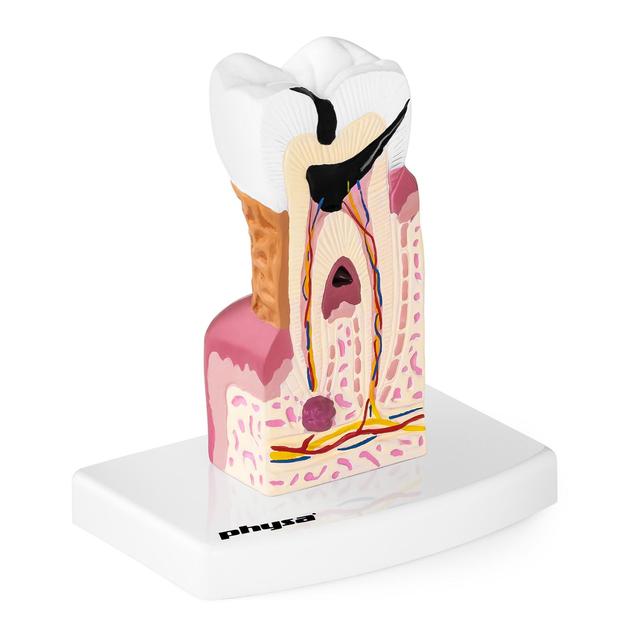 Model de dinte - Molar bolnav on Productcaster.